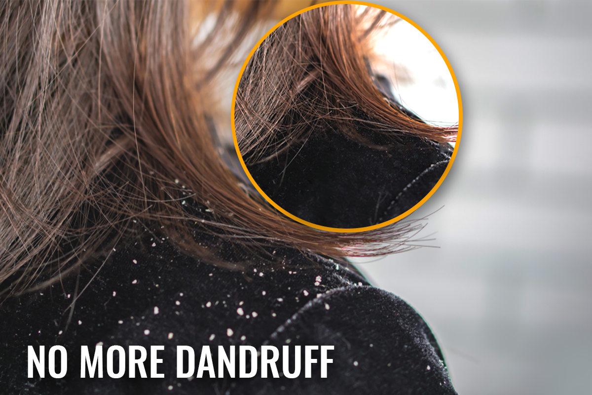 7 Ways to Get Rid of Dandruff Effectively