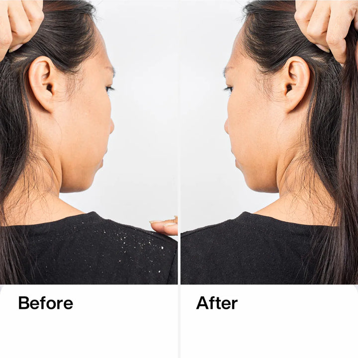 Dandruff Shampoo: How to Choose the Right Formula for Your Scalp